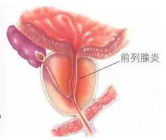 前列腺炎要做哪些检查?正常