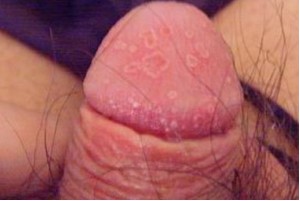 龟头炎图片