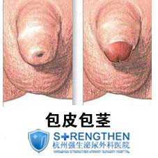 男性包皮过长到底要不要割呢