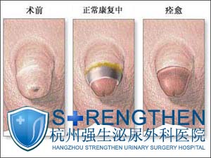 包皮过长一定要及时治疗